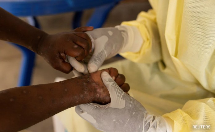 WHO Mengatakan Droplet Merupakan Rute Kecil Penyebaran Mpox. Apa yang Kita Ketahui Sejauh Ini